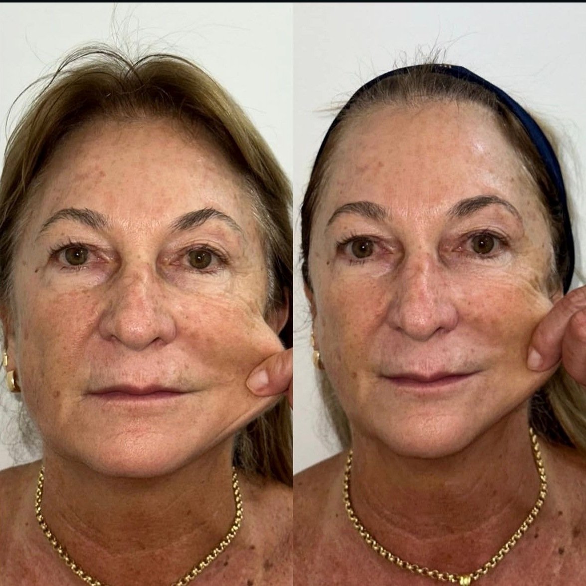 Antes e depois de paciente tratada com o protocolo HiPRO
