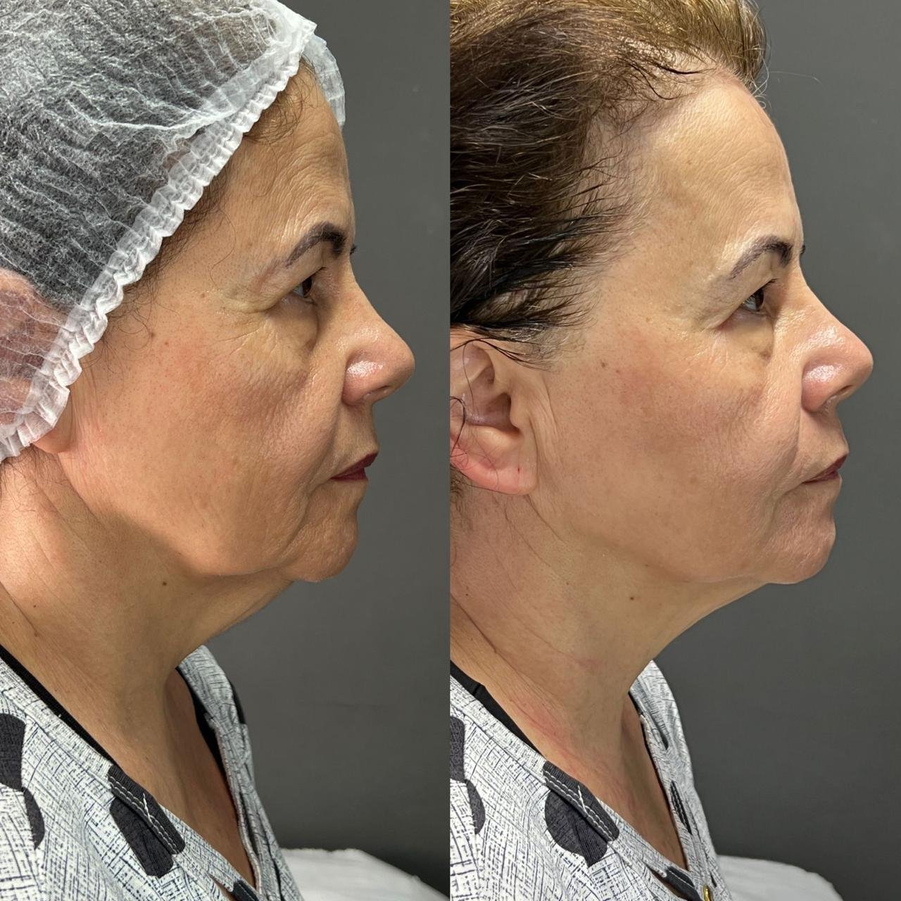 Antes e depois de paciente HiPRO, perfil em estúdio